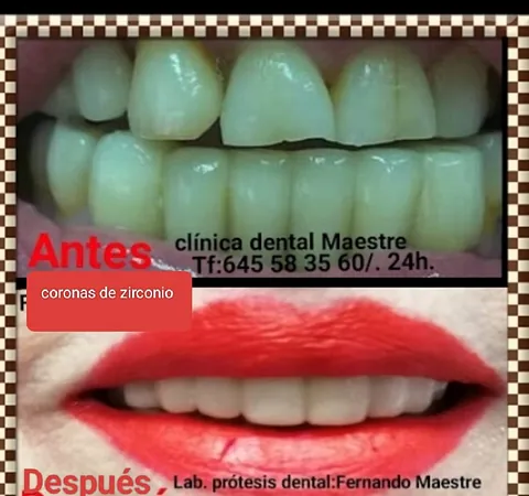Clínica Dental Maestre coronas de zirconio