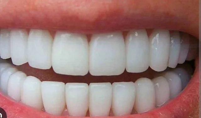 Implantes dentales