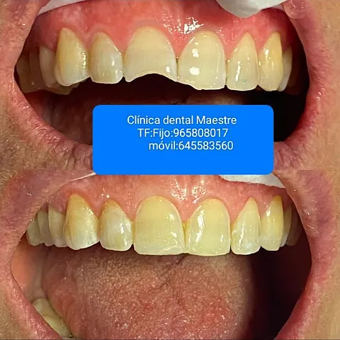 Clínica Dental Maestre Reconstruccion estetica