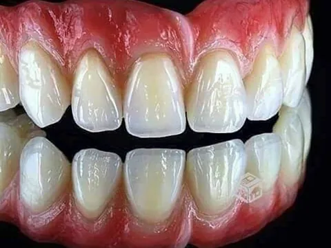 Clínica Dental Maestre Protesis superior