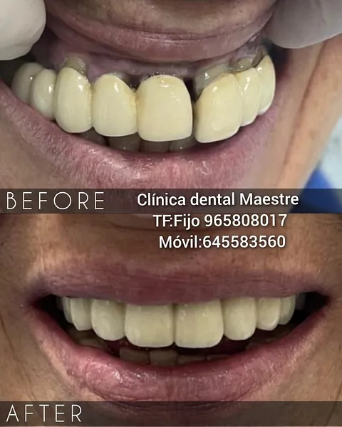 Clínica Dental Maestre protesis mixta
