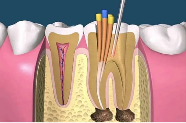 Implantes dentales