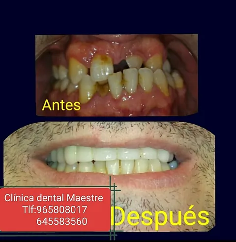 Clínica Dental Maestre Rehabilitación de sus dientes y coronas metal porcelana