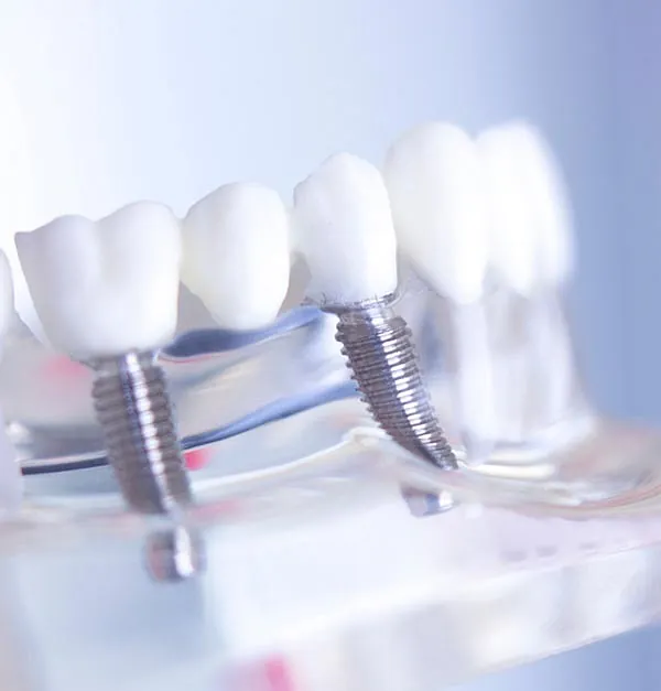 Implantes dentales