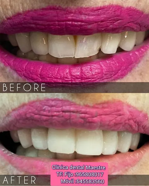 Clínica Dental Maestre blanqueamiento