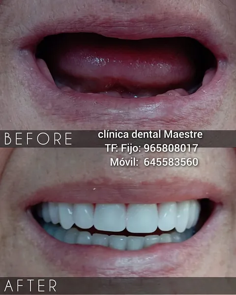 Clínica Dental Maestre Ferula de descarga 
