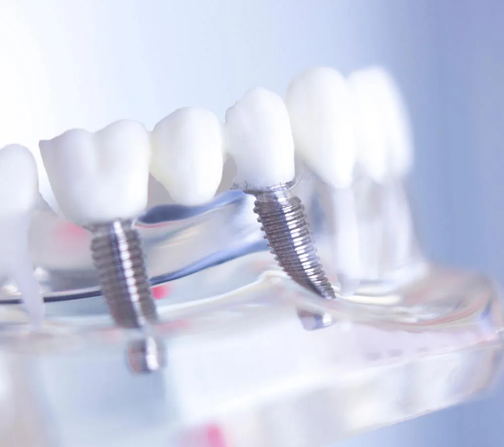 Implantes dentales