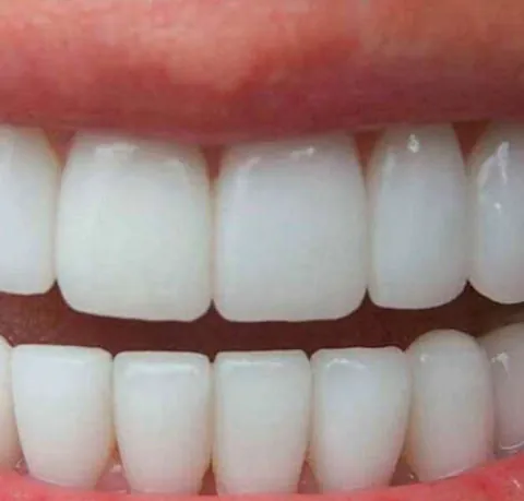 Chica en blanqueamiento dental