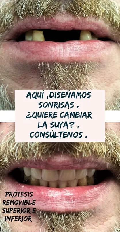 Clínica Dental Maestre blanqueamiento