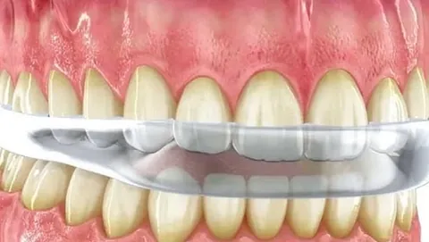 Clínica Dental Maestre blanqueamiento