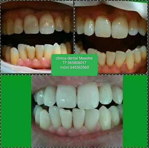 Clínica Dental Maestre blanqueamiento