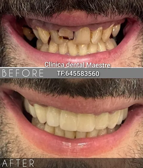Clínica Dental Maestre Rehabilitación de sus dientes y coronas de zircornio