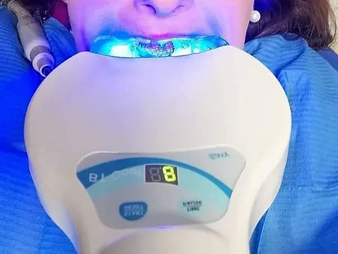 Clínica Dental Maestre blanqueamiento