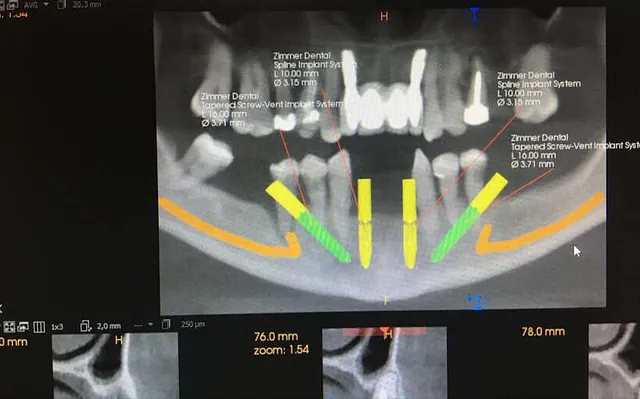 Niño en odontología