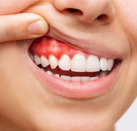Prótesis dental