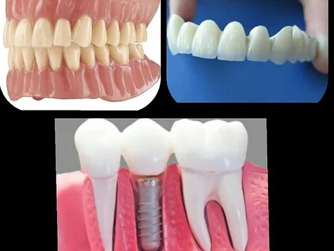 Clínica Dental Maestre Puente de zircornio sobre implantes