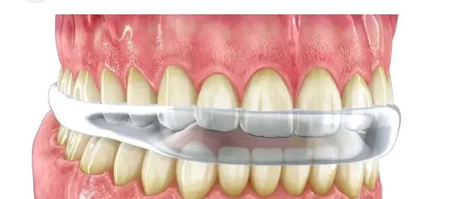 Implantes dentales
