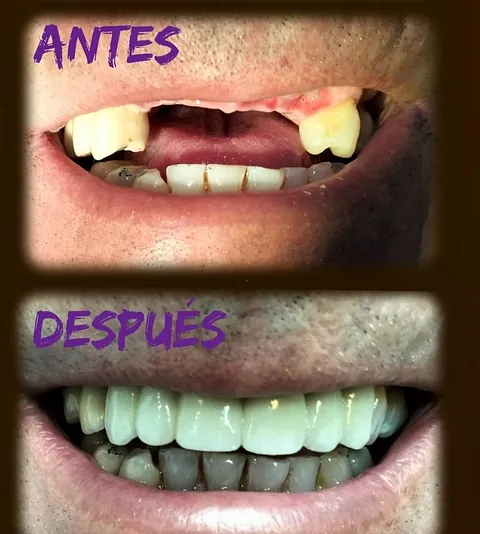 Clínica Dental Maestre Implante y protesis en un día 