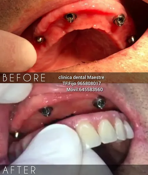 Clínica Dental Maestre Implante y protesis en un día 