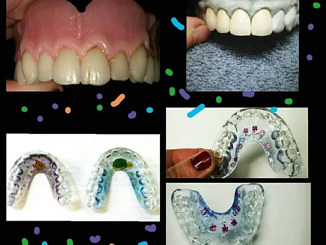 Clínica Dental Maestre ferula de descarga 